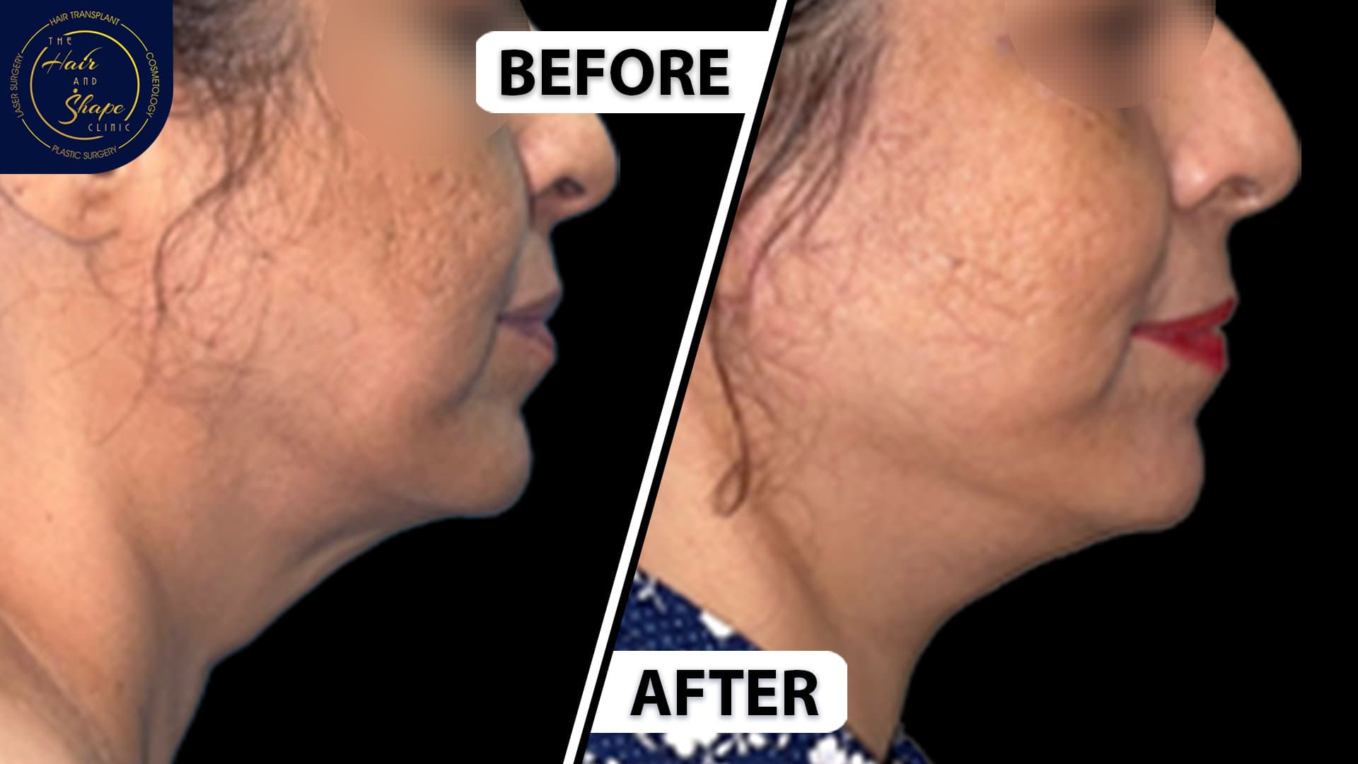 Face & Neck Lift result5
